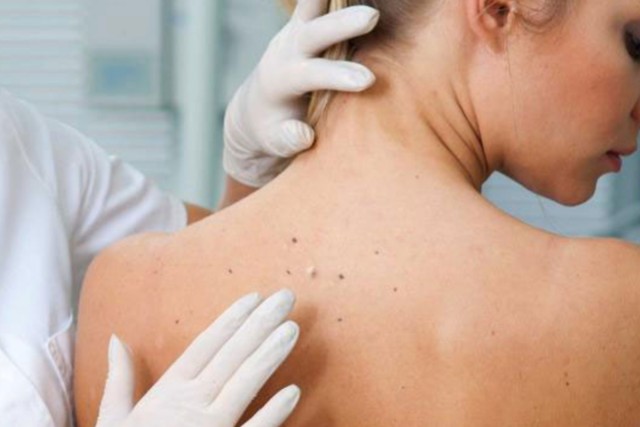 The ABCDEs of Melanoma: The 5 Signs for Early Detection.